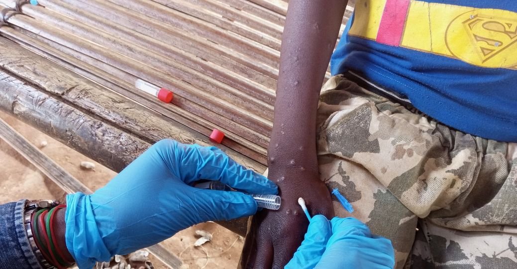 Guiné-Bissau prepara plano de contingência e sem capacidade de testar  Mpox  