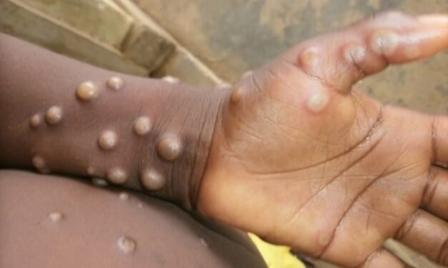 Embaixada da Guiné-Bissau em Gâmbia alerta  funcionários  sobre  identificação do primeiro caso de M-Box neste país vizinho