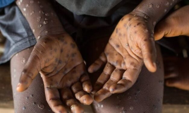Guiné-Bissau regista primeiro caso suspeito de “Mpox” na região de Bafatá