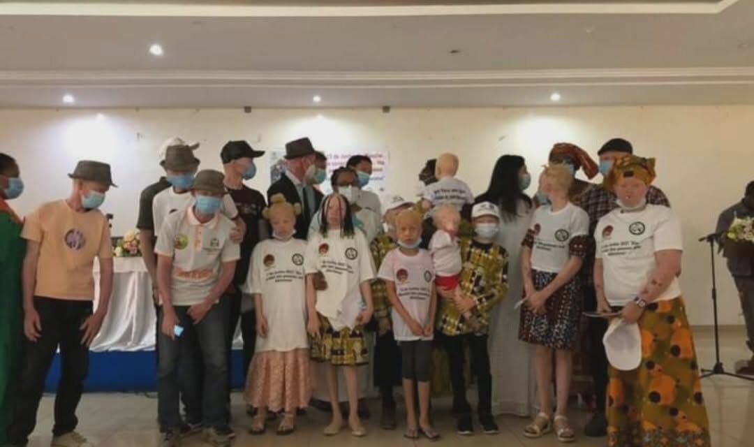Associação Juvenil apela ao reforço da proteção e inclusão das pessoas com albinismo na Guiné-Bissau