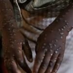 Primeiro caso de MPOX confirmado na Guiné-Bissau e coloca autoridades em alerta