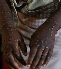 Primeiro caso de MPOX confirmado na Guiné-Bissau e coloca autoridades em alerta